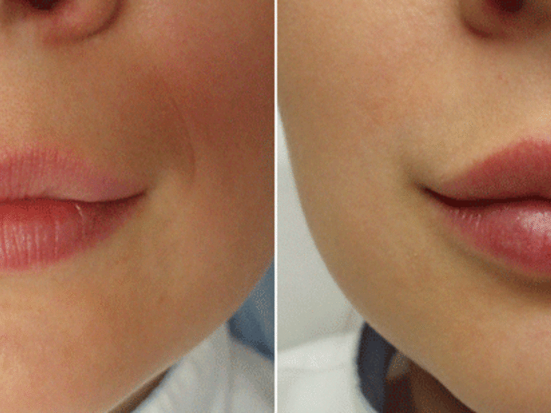 Увеличение губ до и после фото 1 мл тонкие губы