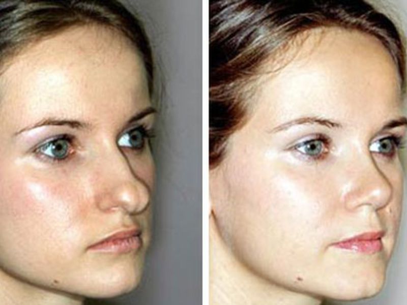 Сужение кончика носа без операции до и после фото