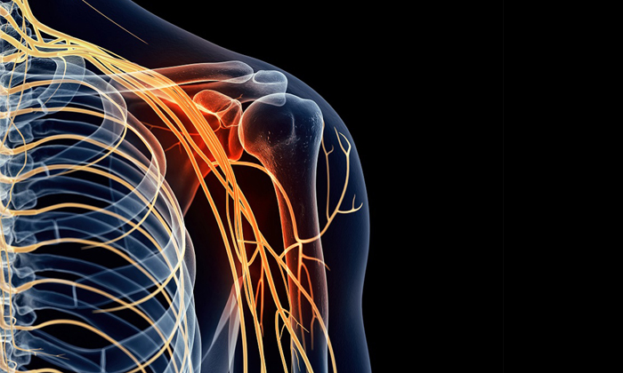 Причины и лечение неврита плечевого нерва
