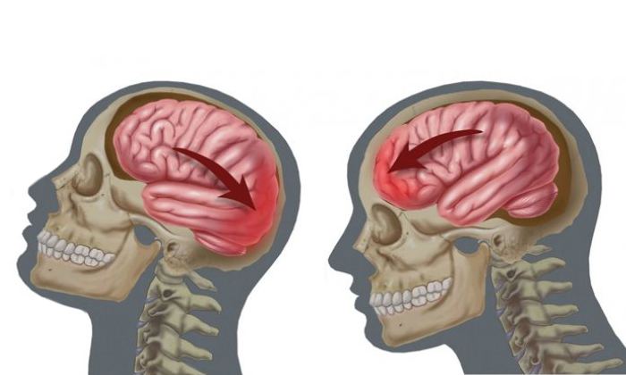 Симптомы, степени и причины сотрясения мозга