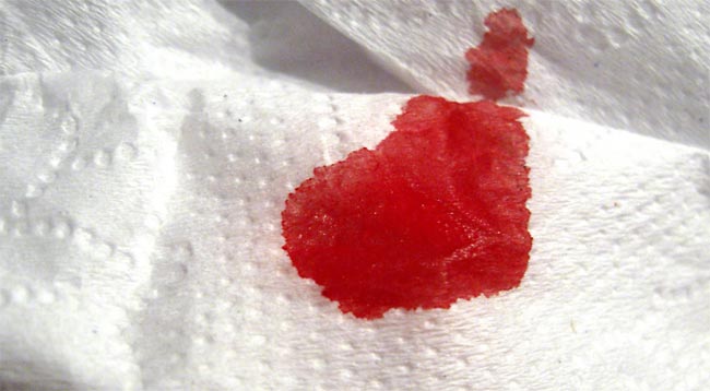 кровь на туалетной бумаге после дефекации