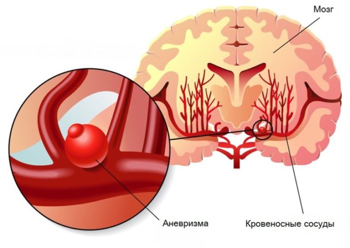 Аневризма сосудов головного мозга