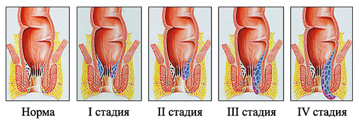 Стадии геморроя