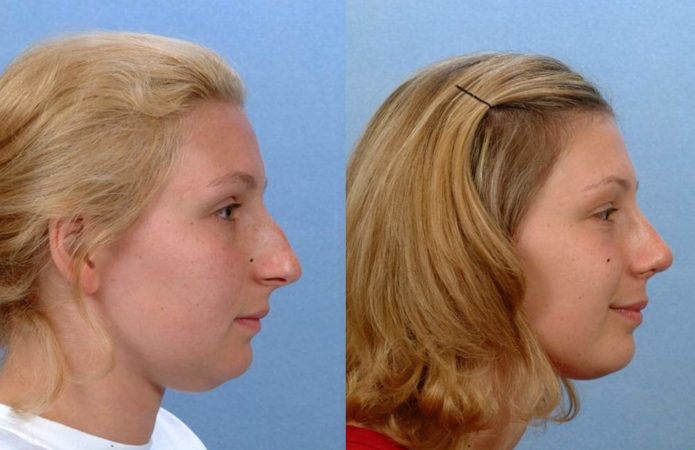 Фронтопластика. Ринопластика фото до и после. Ринопластика волос до и после. Краниопластика операция ЛО И после. Краниопластика до и после.