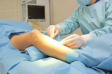 Лечение варикоза на ногах с помощью операций