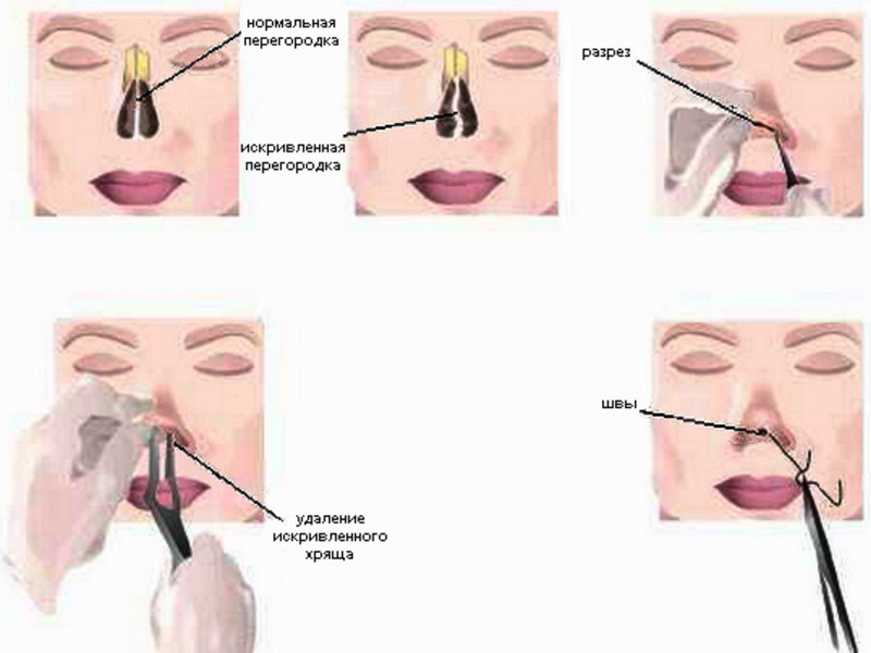 Можно вправить нос. Операция перегородка носа септопластика. Септопластика искривление носовой перегородки. Выправление носовой перегородки операция. Операция искривление перегородки лазером.