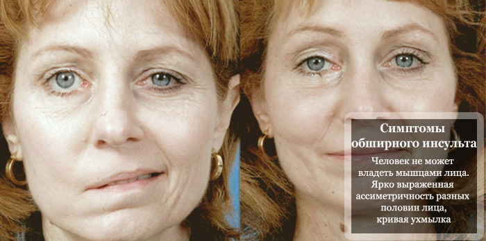 Инсульт фото людей до и после