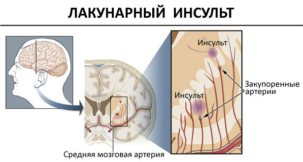 Лакунарный инсульт головного мозга