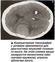 Компьютерная томография мозга: все за и против