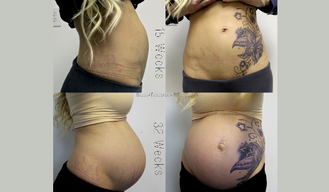 Татуировки на животе у девушек после родов: фото, когда стоит делать