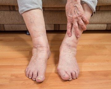 О чем говорят отеки ног у пожилых людей и как с ними бороться?
