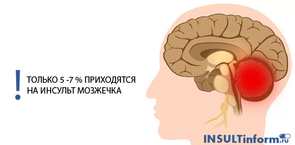 Инсульт мозжечка головного мозга