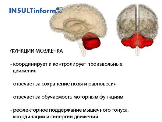 Инсульт мозжечка головного мозга