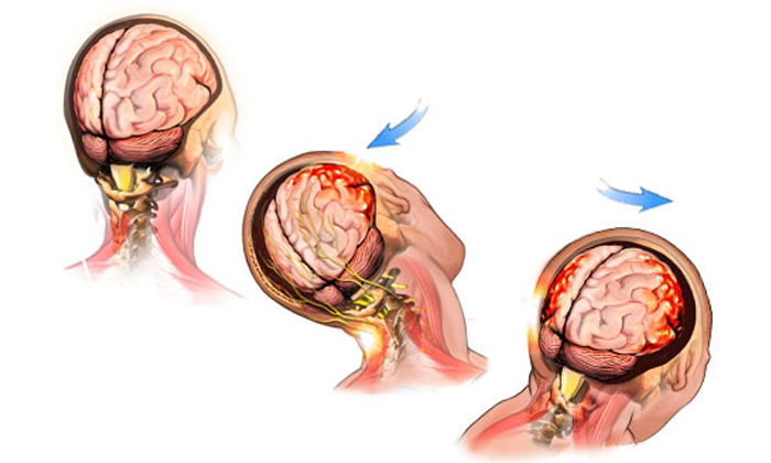 Отличия сотрясения и ушиба головного мозга