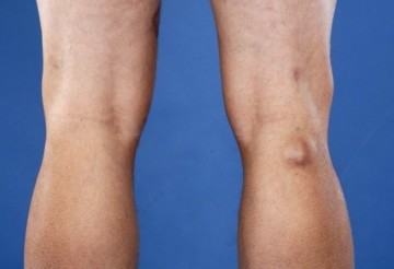 Варикоз под коленом: симптомы, успешное лечение